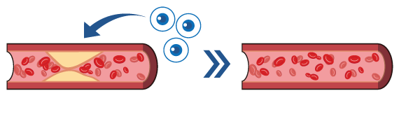 動脈硬化血管の修復