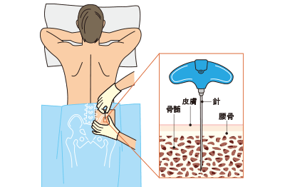 骨髄液採取