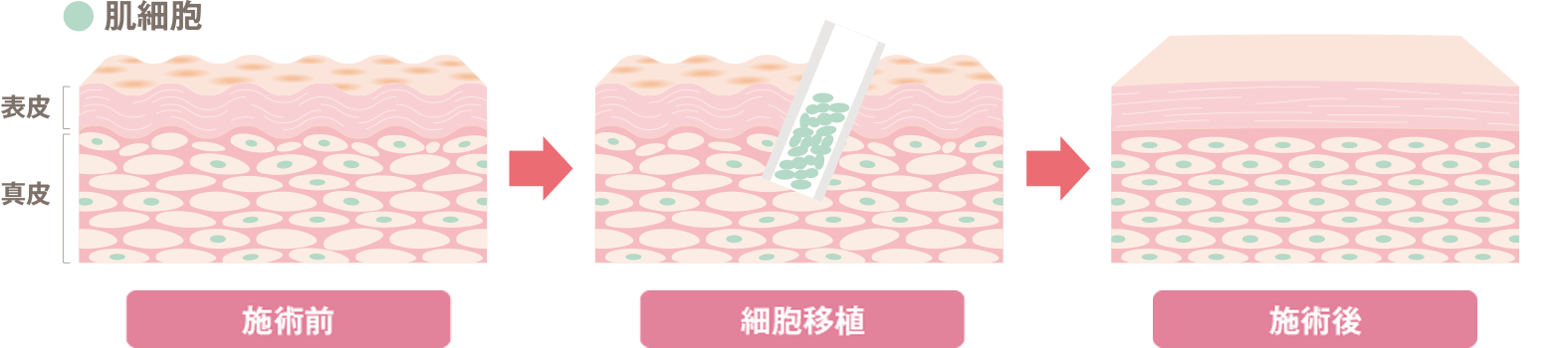 施術前、細胞移植、施術後の肌細胞