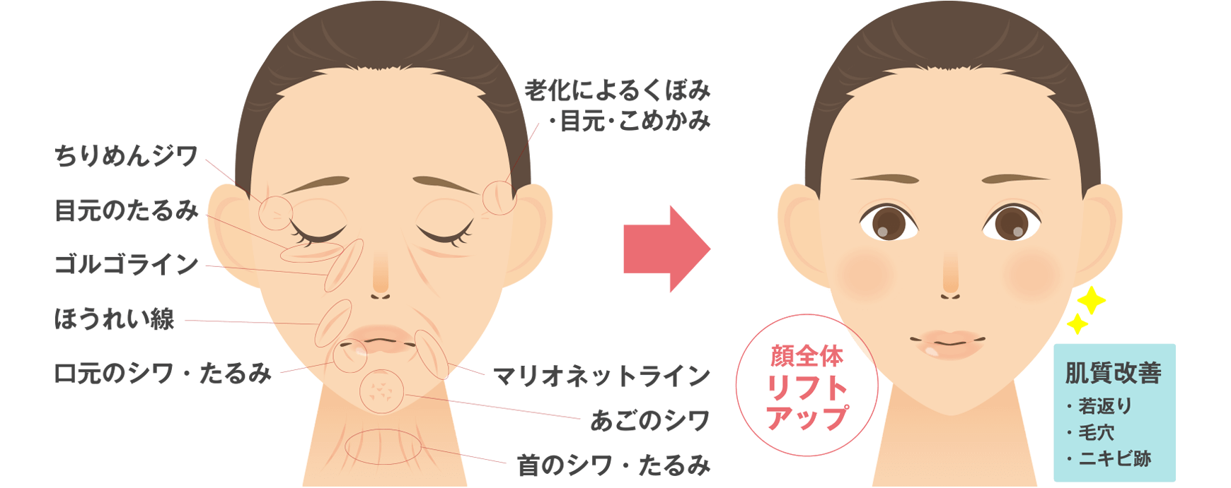 顔全体リフトアップ、肌質改善